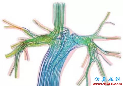 看ANSYS公司如何利用CFD助力心臟病患者手術(shù)fluent分析圖片4